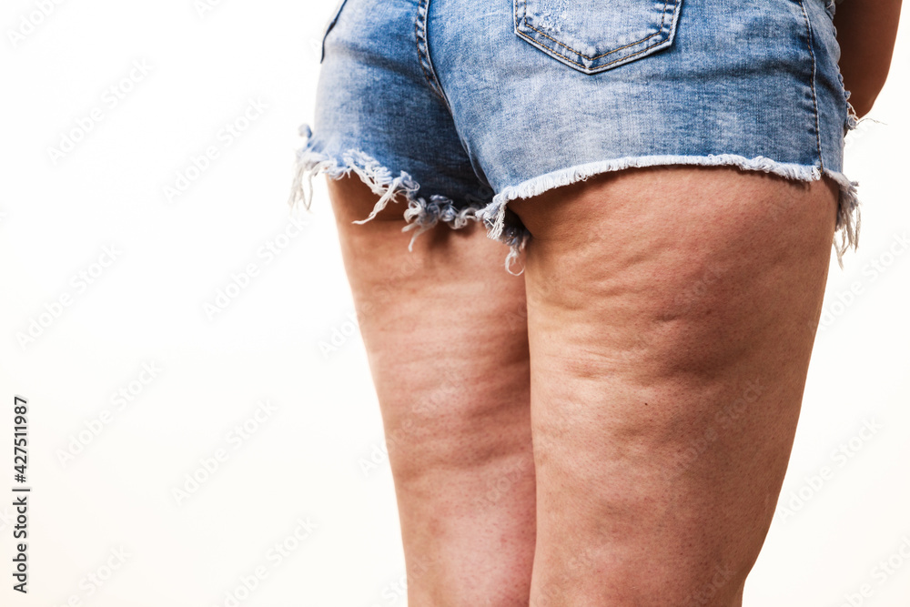Woman legs with cellulite skin - obrazy, fototapety, plakaty 