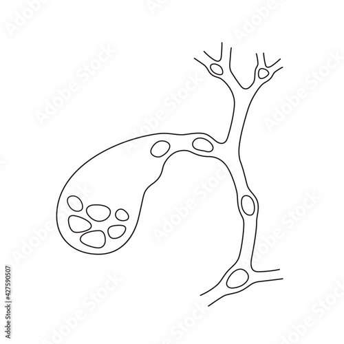 Variants of the location of stones in the gallbladder and bile ducts. Schematic drawing for cholelithiasis, gallstone disease. Isolated vector illustration on white background photo