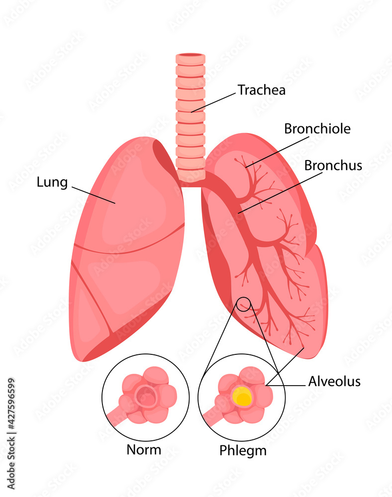 Pneumonia. Normal and inflammatory condition of the lungs and inflammation of the alveoli with fluid. vector illustration in cartoon style isolated on white background.