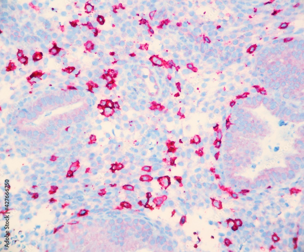 Endometrium tissue infiltrated by numerous natural killer cells which cause infertility. The cells are red with this CD 56 stain. Microscopic view.