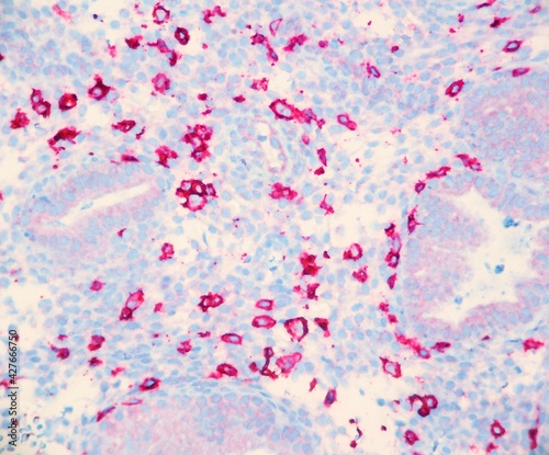 Foto Endometrium tissue infiltrated by numerous natural killer cells which cause infertility