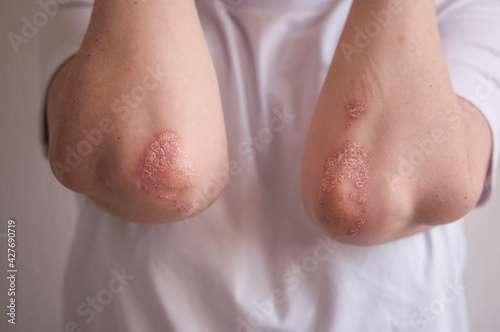 psoriasis on the skin of the elbow of a young woman in a white T-shirt. close-up