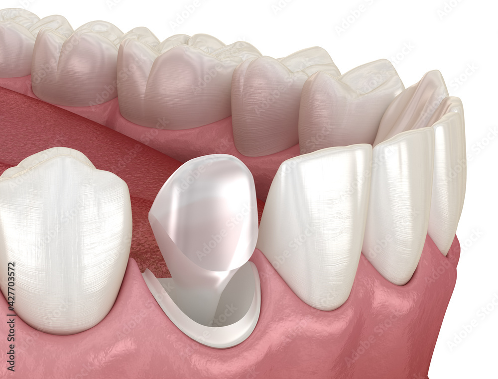 Stump pin tab on canaine tooth. Medically accurate dental 3D