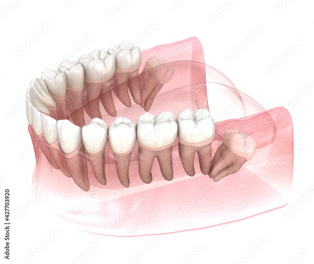 Obraz premium Distal impaction of Wisdom tooth. Medically accurate tooth 3D illustration