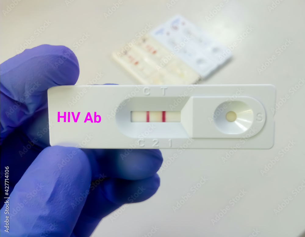HIV positive test result by using rapid test cassette