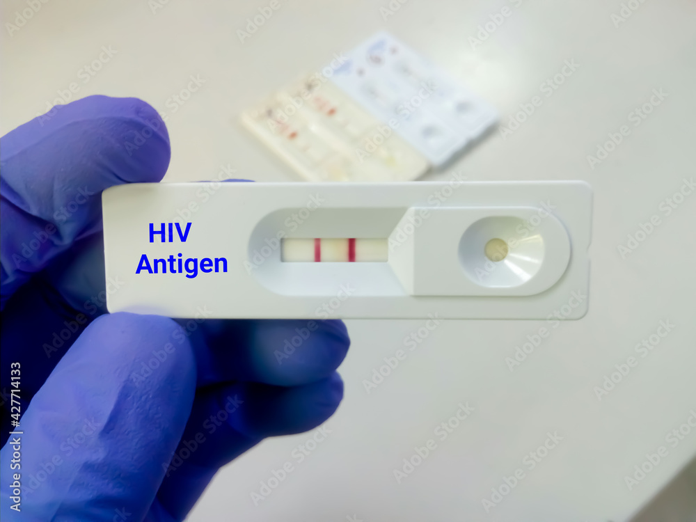 HIV antigen positive test result by using rapid test cassette HIV antigen positive test result by using rapid test cassette