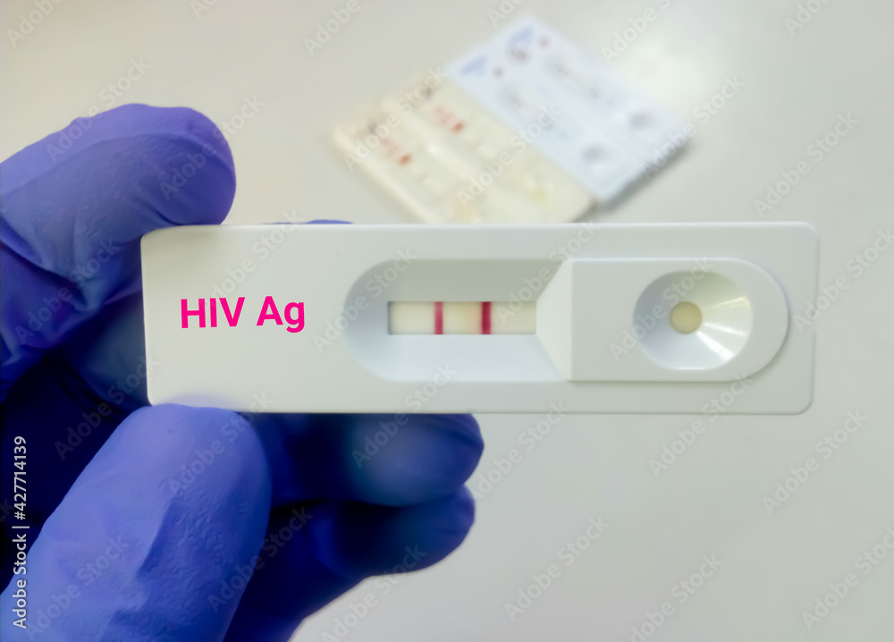 HIV antigen positive test result by using rapid test cassette HIV antigen positive test result by using rapid test cassette