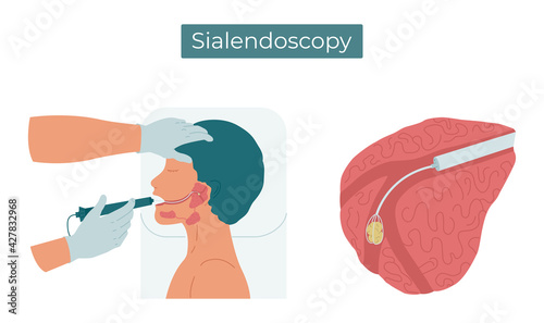 Vector flat illustration of sialendoscopy. Surgery to remove a stone from the duct of the parotid salivary gland. photo