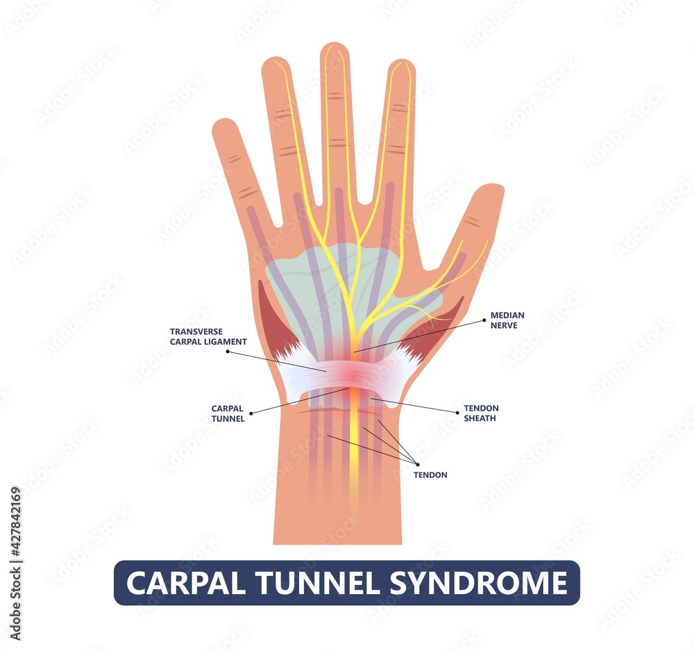 Carpal Tunnel Syndrome Pain Hand Arm Wrist Splint Surgery Bone Flexor 