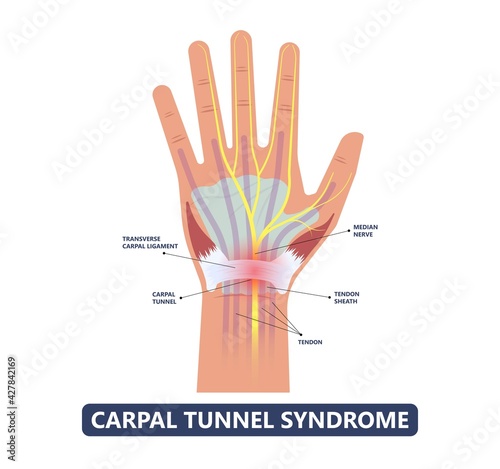 Carpal Tunnel Syndrome pain hand arm wrist splint surgery bone flexor fingers thumb muscle Brace index middle ring work limb palm mouse keyboard photo