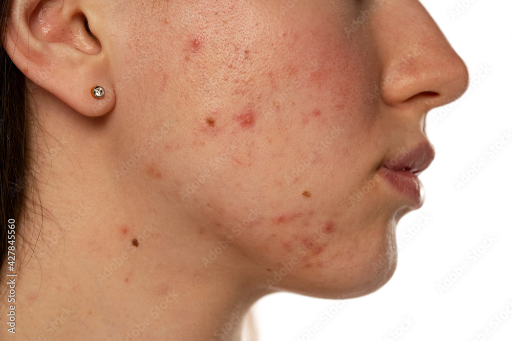 Closeup of a female face with problematic skin Closeup of a female face with problematic skin