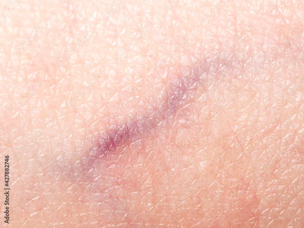 Fototapeta premium Older woman with varicose veins