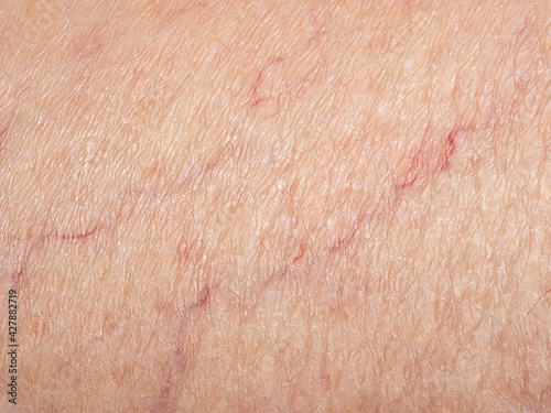 Older woman with varicose veins photo