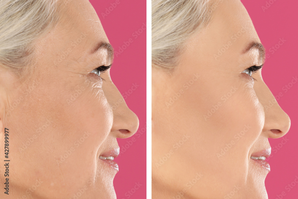 Obraz premium Collage with photos of mature woman before and after biorevitalization procedure on pink background, closeup