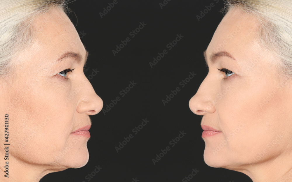 Beautiful mature woman before and after cosmetic procedure on black background, collage. Plastic surgery Beautiful mature woman before and after cosmetic procedure on black background, collage. Plastic surgery
