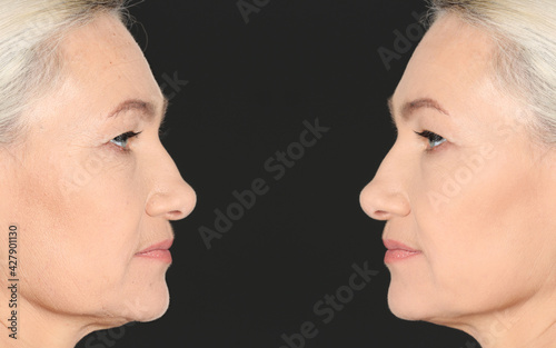 Beautiful mature woman before and after cosmetic procedure on black background  collage. Plastic surgery
