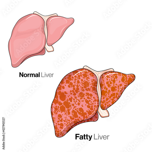 Normal and fatty liver comparison. 