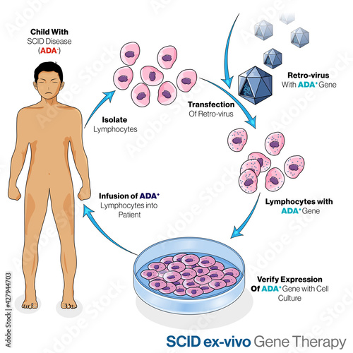 Illustration of treatment for Severe combined immunodeficiency(SCID) using Ex vivo gene therapy.