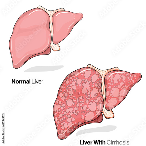 Illustration of liver cirrhosis disease or condition Along with healthy liver. 