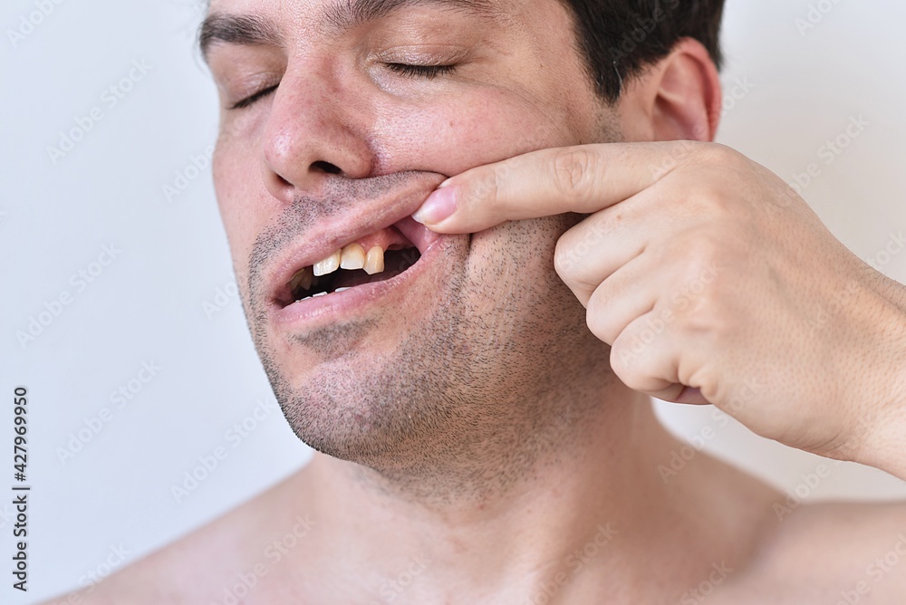 portrait of a man with broken teeth