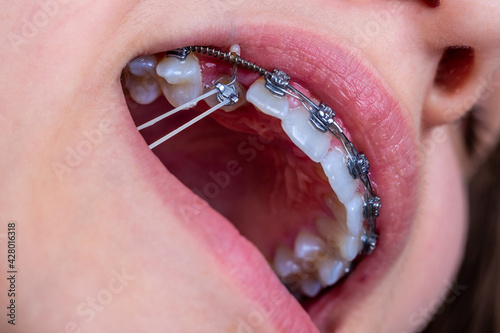Close up of orthodontist hands putting elastic rubber band on patient brackets.