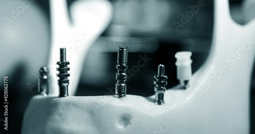 Titanium abutments in the artificial jawbone close-up