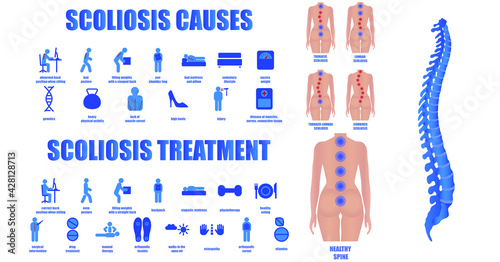 Scoliosis infographics. A set of icons on the topic of the causes and treatment of scoliosis. Curvature of the spine. Image of a healthy and uneven back of a girl. Medical educational poster.
