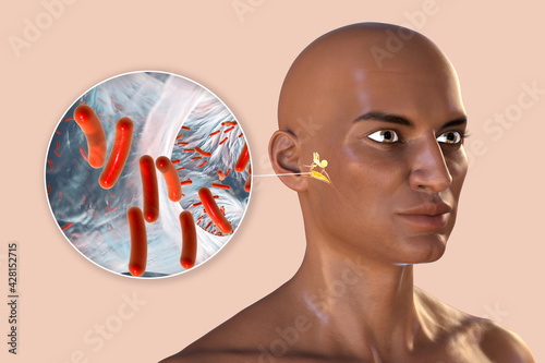 Otitis media, inflammatory disease of the middle ear, and closeup view of bacteria that cause otitis media photo