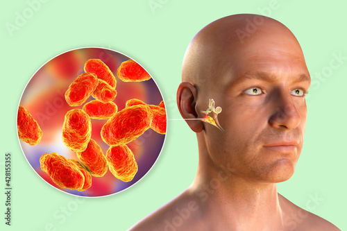 Haemophilus influenzae bacteria as a cause of otitis media photo