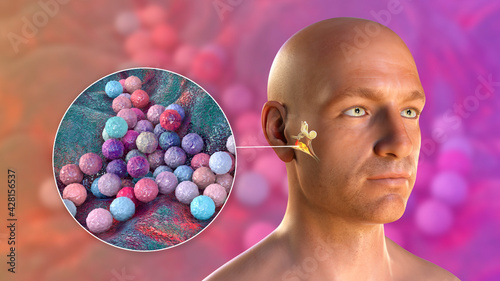 Staphylococcus aureus bacterium as a cause of otitis media photo