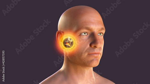 Otitis media, a group of inflammatory diseases of the middle ear, 3D illustration photo