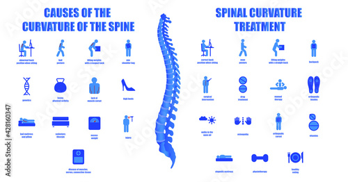 Causes and treatment of scoliosis. Infographics on the topic of posture disorders. Icons denoting curvature of the spine and methods of preventing back diseases. Medical educational poster.