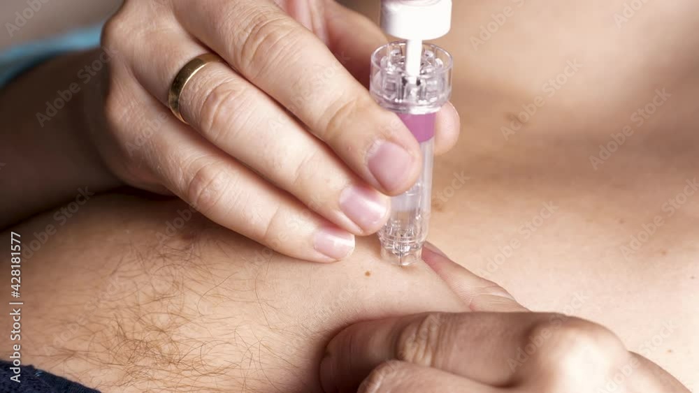 Self-injection in the Abdomen in the Treatment of Coronavirus. Male Hand Using Automatic Syringe For Injection Medicine at Home. Health and Medical Concepts in Worldwide Pandemic Self-injection in the Abdomen in the Treatment of Coronavirus. Male Hand Using Automatic Syringe For Injection Medicine at Home. Health and Medical Concepts in Worldwide Pandemic