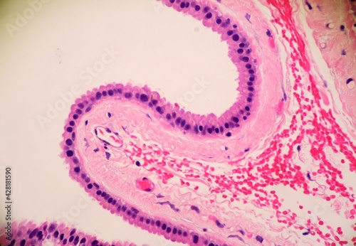Cellular lining of a cystic lesion called apocrine hidrocystoma. Microscopic view.
