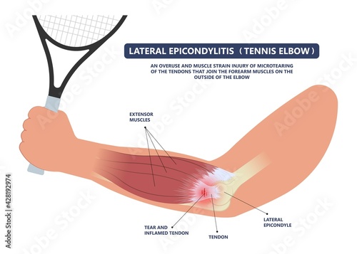 Tennis elbow pain inflammation tendon grip weak Golfer golf sport wrist brace tissue rupture limb arm photo