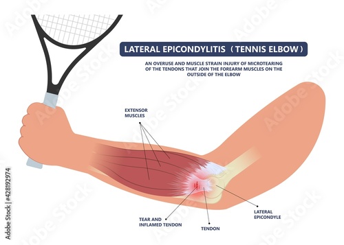 Tennis elbow pain inflammation tendon grip weak Golfer golf sport wrist brace tissue rupture limb arm
