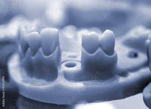 Konstfotografi Collapsible jaw model with teeth and holes for the implant crown abutment