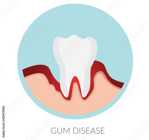White Teeth - Gum Disease - stock illustration