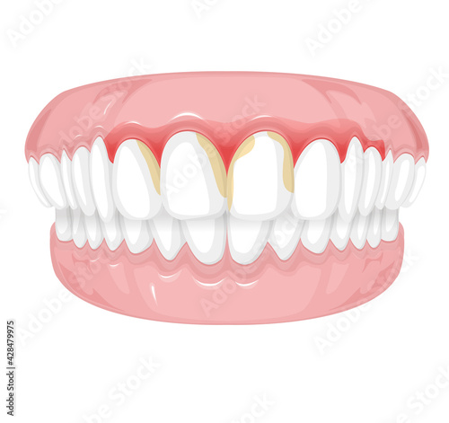 Tender Gums with Plaque - stock illustration