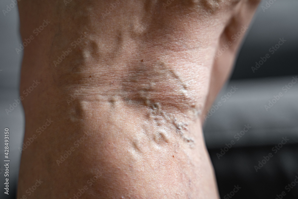 Varicose vein close up leg. Senior woman health problem. Foot with Diseased Veins. Health Care, Podiatry. Varicose vein close up leg. Senior woman health problem. Foot with Diseased Veins. Health Care, Podiatry.