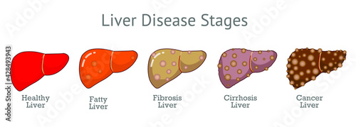 Liver disease stages. Progression damage healthy liver, fatty  fibrosis, cirrhosis, cancer steps. Tumorous deterioration that grows from red to dark brown. alcohol and unhealthy diet. Drawing vector photo