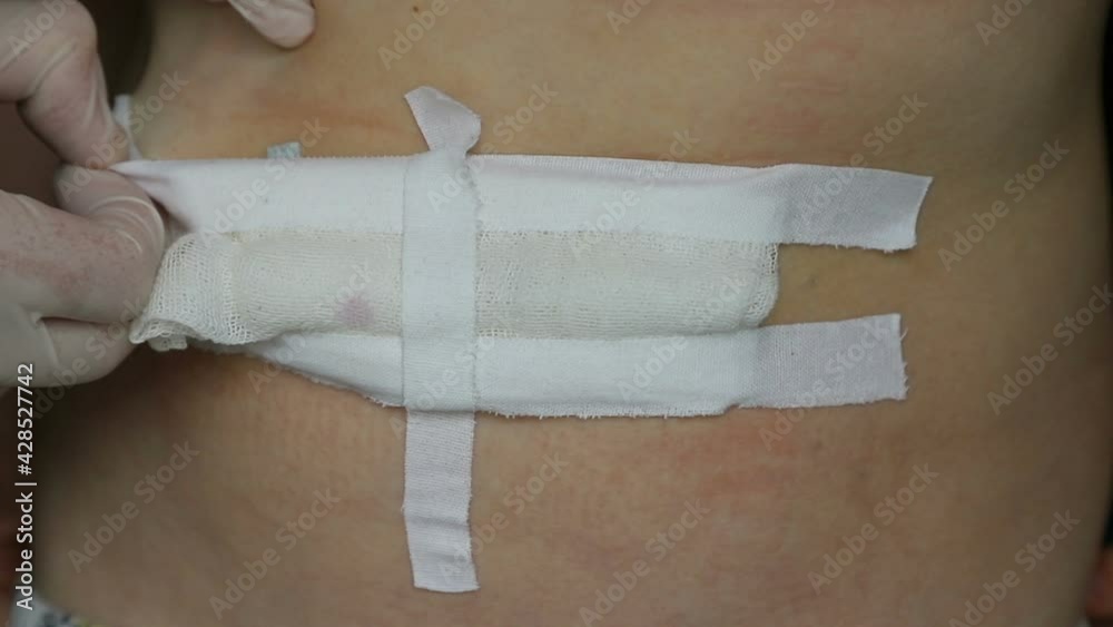 Bandaging. Removal of gauze bandage for treatment of surgical sutures on child abdomen after