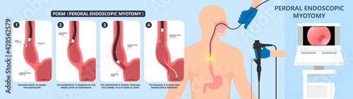POEM Per oral surgery treat surgical GERD tract lower food damage nerves acid reflux pain barium swallow motility balloon diffuse spasm outflow upper biopsy heller