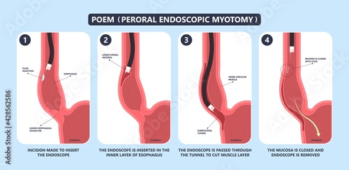 POEM Per oral surgery treat surgical GERD tract lower food damage nerves acid reflux pain barium swallow motility balloon diffuse spasm outflow upper biopsy heller