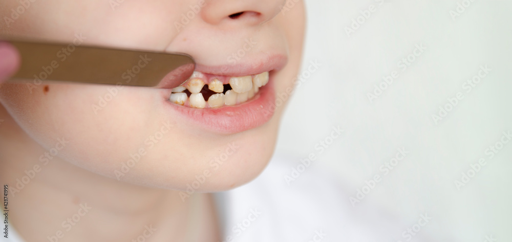 Hypoplasia of the enamel of the front teeth. Yellow plaque on the tooth enamel. Close-up.