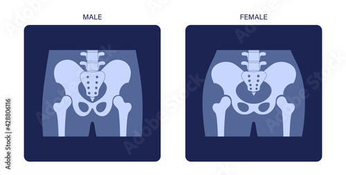 Muscular pelvis xray