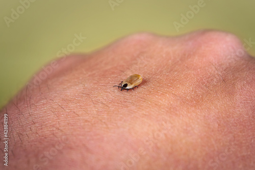 Engorged tick on a human skin. Lyme disease caused by borrelia. photo