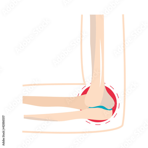 rheumatism joint pain