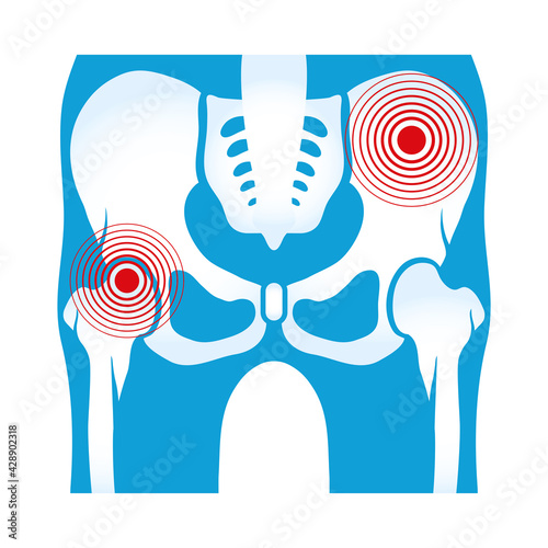 hips rheumatological pain