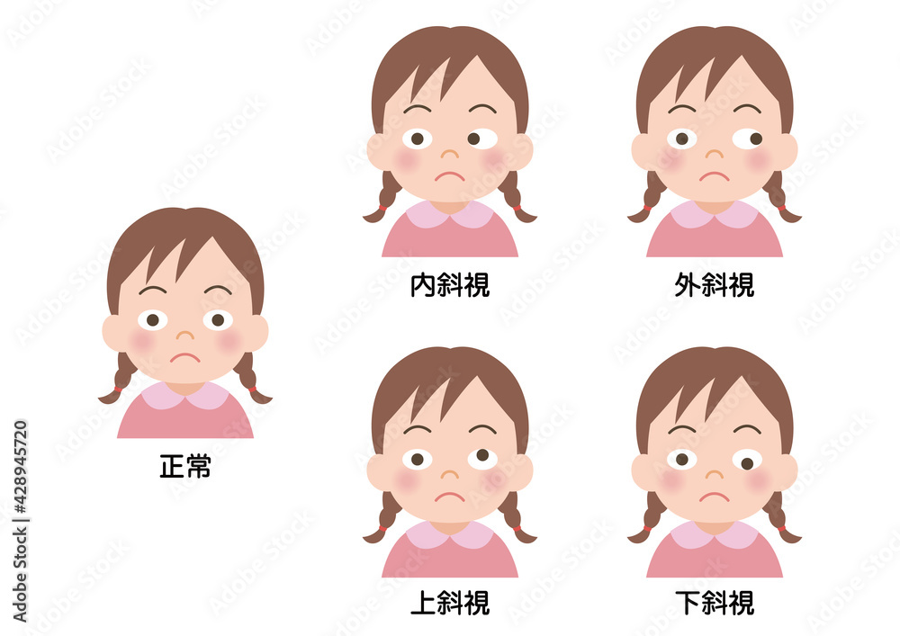 斜視の女の子のイラスト 斜視の女の子のイラスト